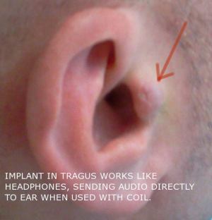 ear implant annotated