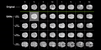 Nvidia researchers develop AI system that generates synthetic scans of brain cancer