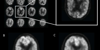 Computer vision identifies signs of early Alzheimer’s up to 6 years before clinical diagnosis
