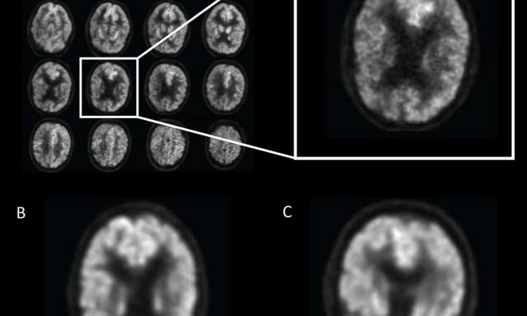 AI brain scan