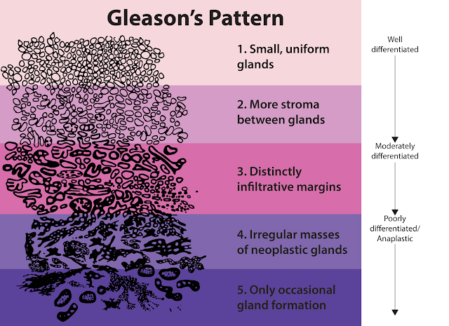 Gleason patterns