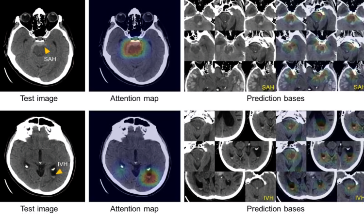 AI brain scan