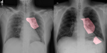 DarwinAI wants to help identify coronavirus in X-rays, but radiologists aren’t convinced